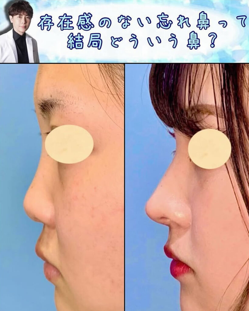 鼻中隔延長と鼻尖形成と軟骨移植と 頬と顎下の脂肪吸引の症例写真 (1)