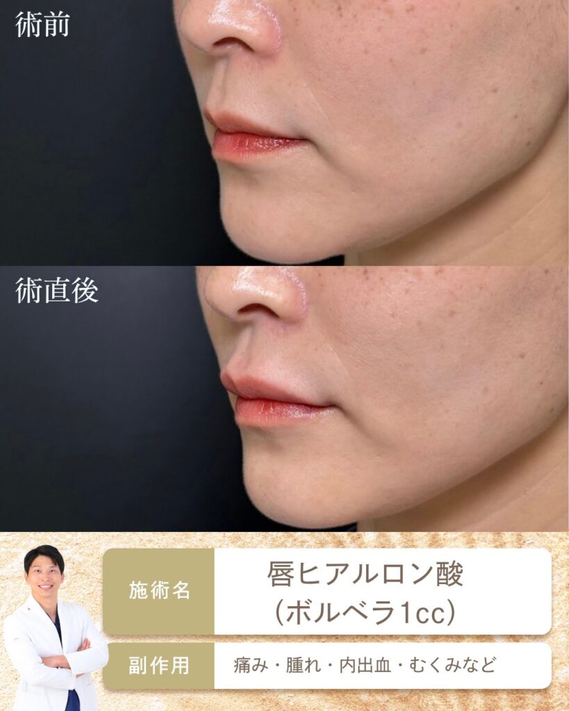 唇のヒアルロン酸 の症例写真 (2)