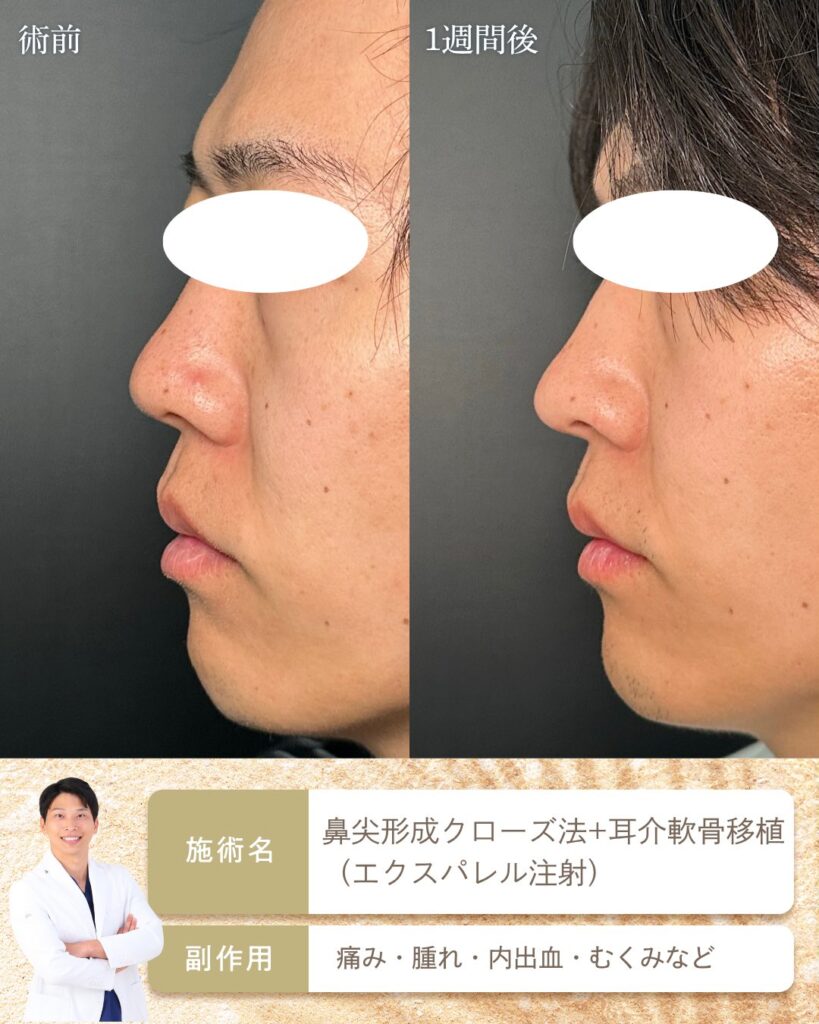 鼻尖形成と耳介軟骨移植を受けた男性の症例写真 (2)