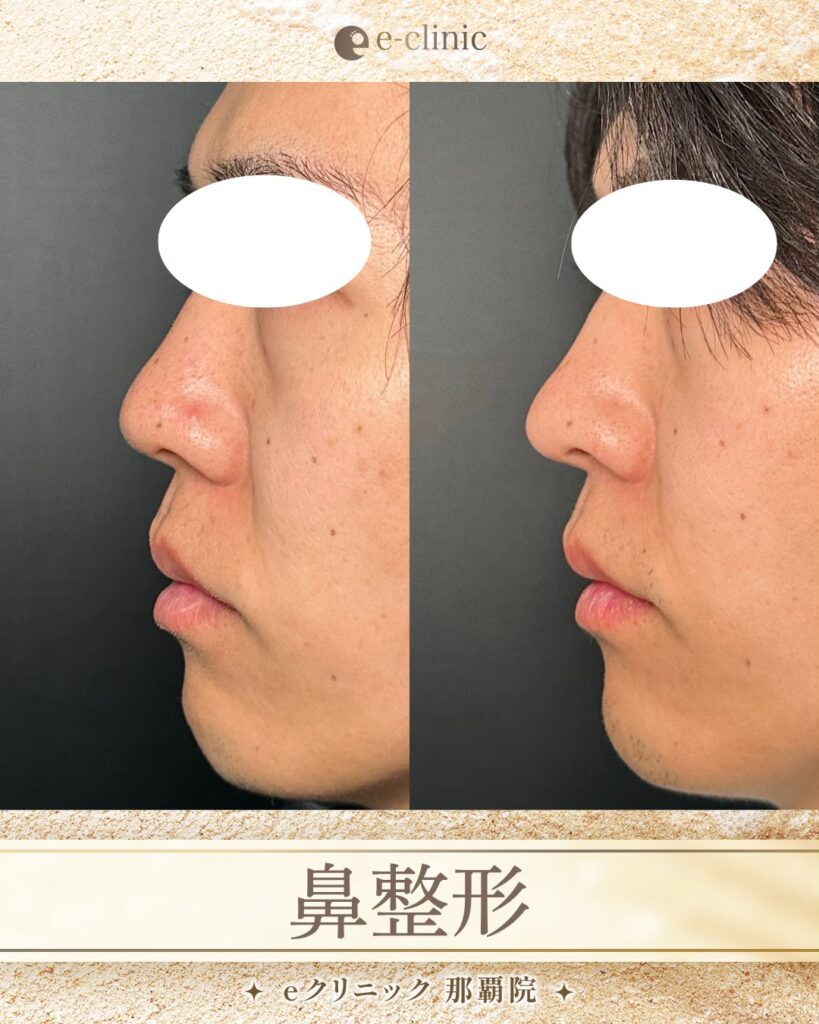 鼻尖形成と耳介軟骨移植を受けた男性の症例写真 (1)