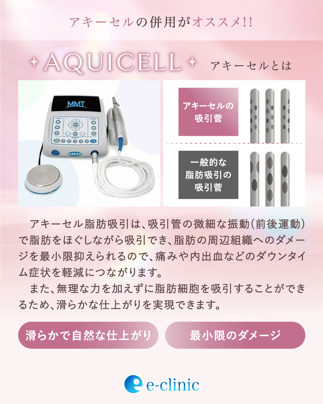 脂肪豊胸キャンペーンのバナー