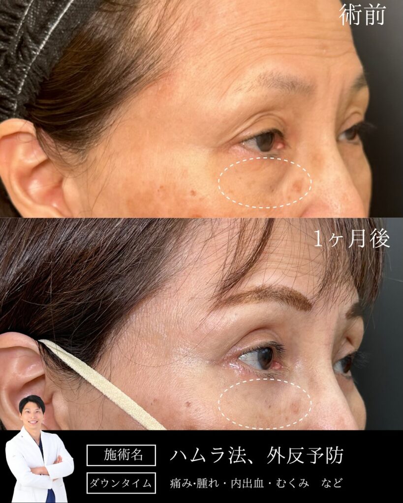 裏ハムラ法の症例写真 (2)