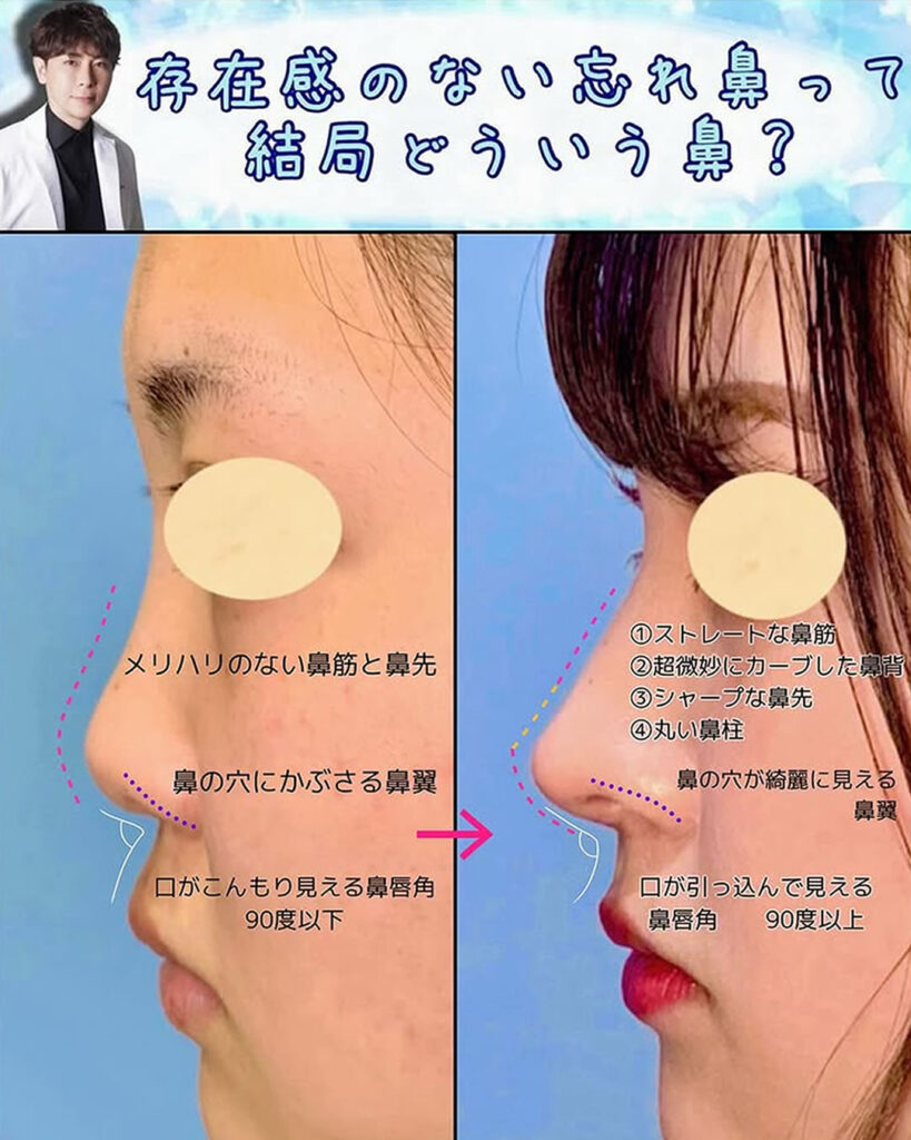 鼻中隔延長と鼻尖形成と軟骨移植と 頬と顎下の脂肪吸引の症例写真 (2)