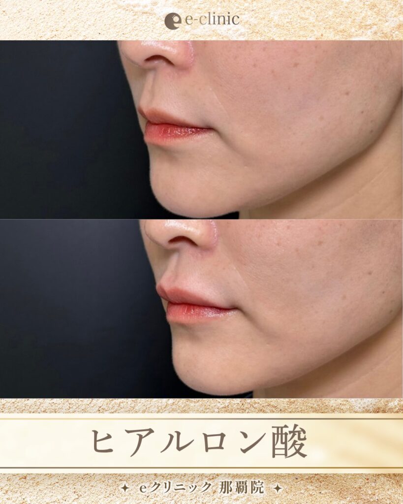 唇のヒアルロン酸 の症例写真 (1)