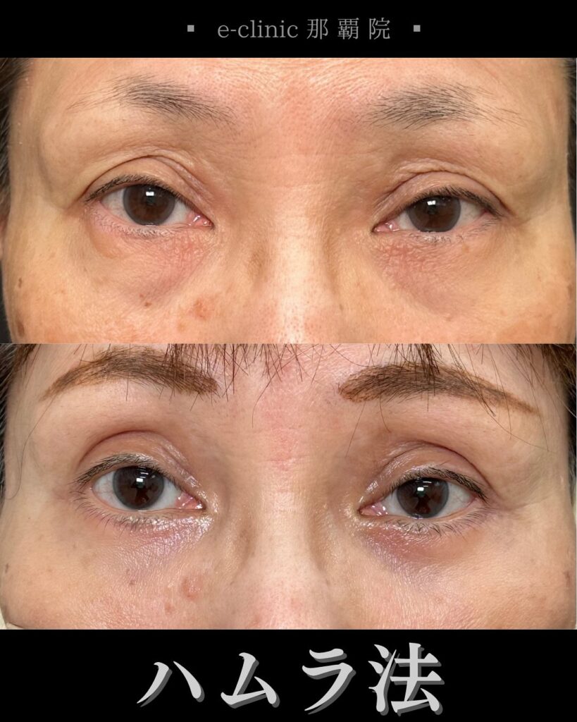 裏ハムラ法の症例写真 (1)