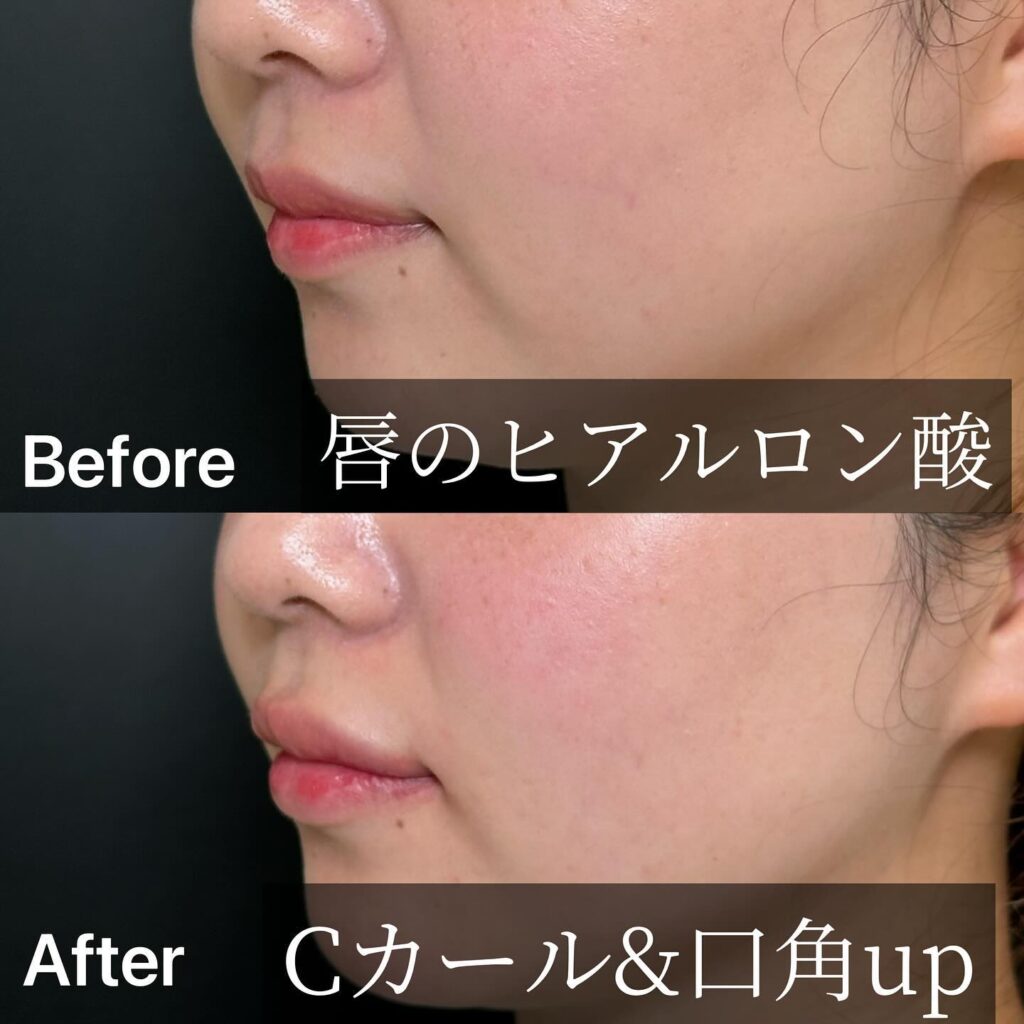 唇のヒアルロン酸の症例写真 (24)