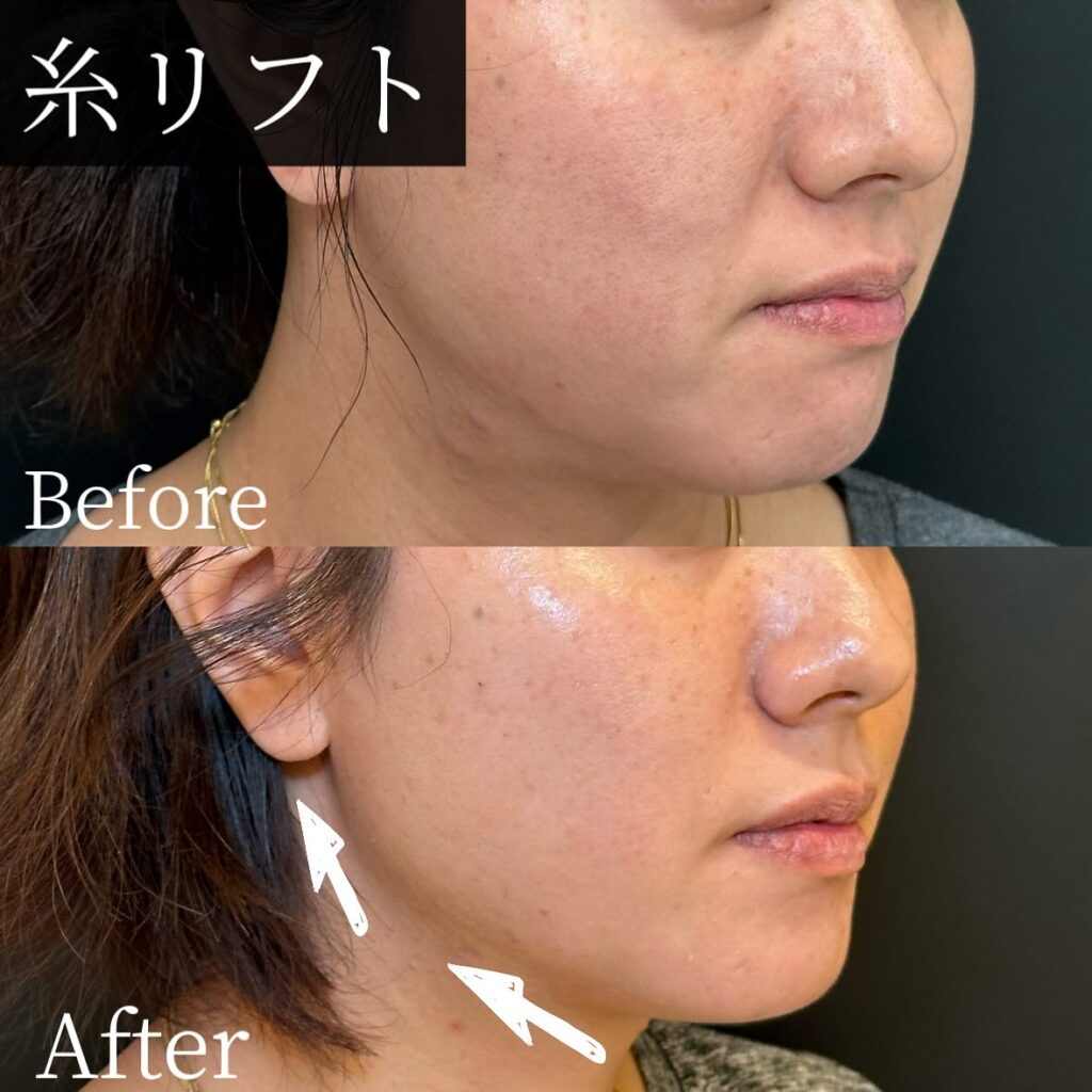 糸リフトの症例写真 (20)