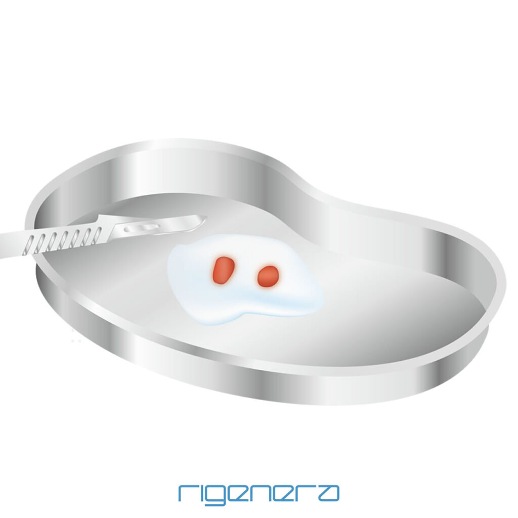 採取した真皮結合組織