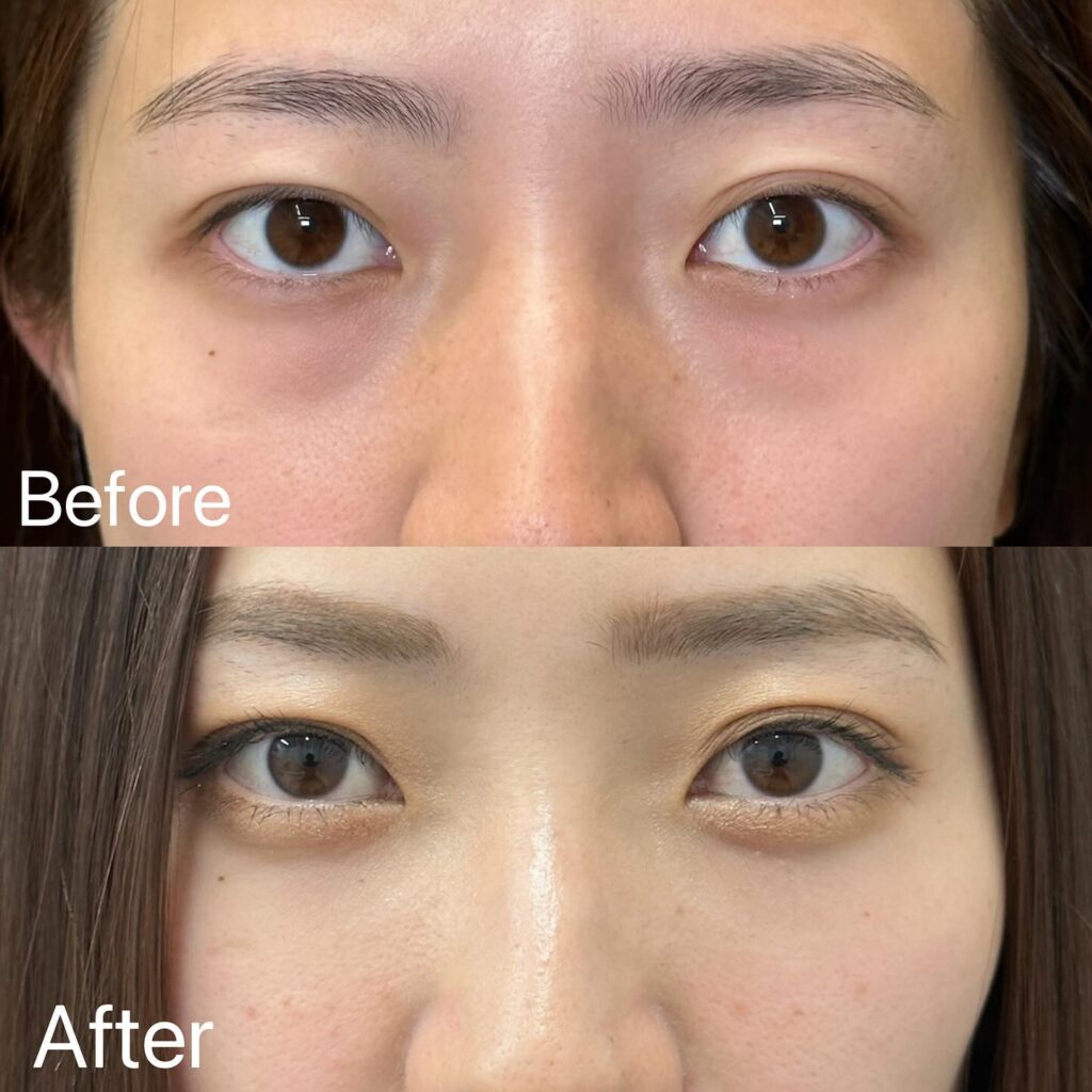 裏ハムラ法の症例写真 (24)