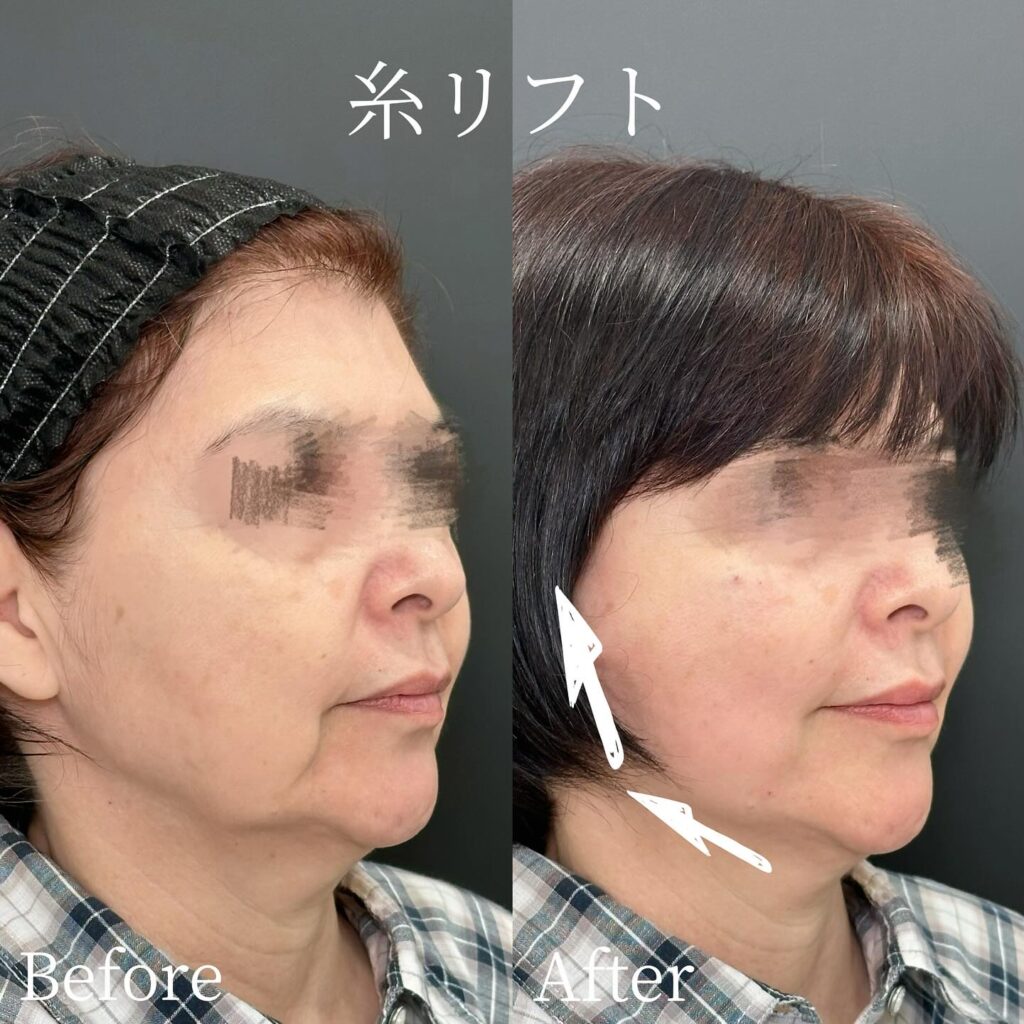 糸リフトの症例写真 (35)