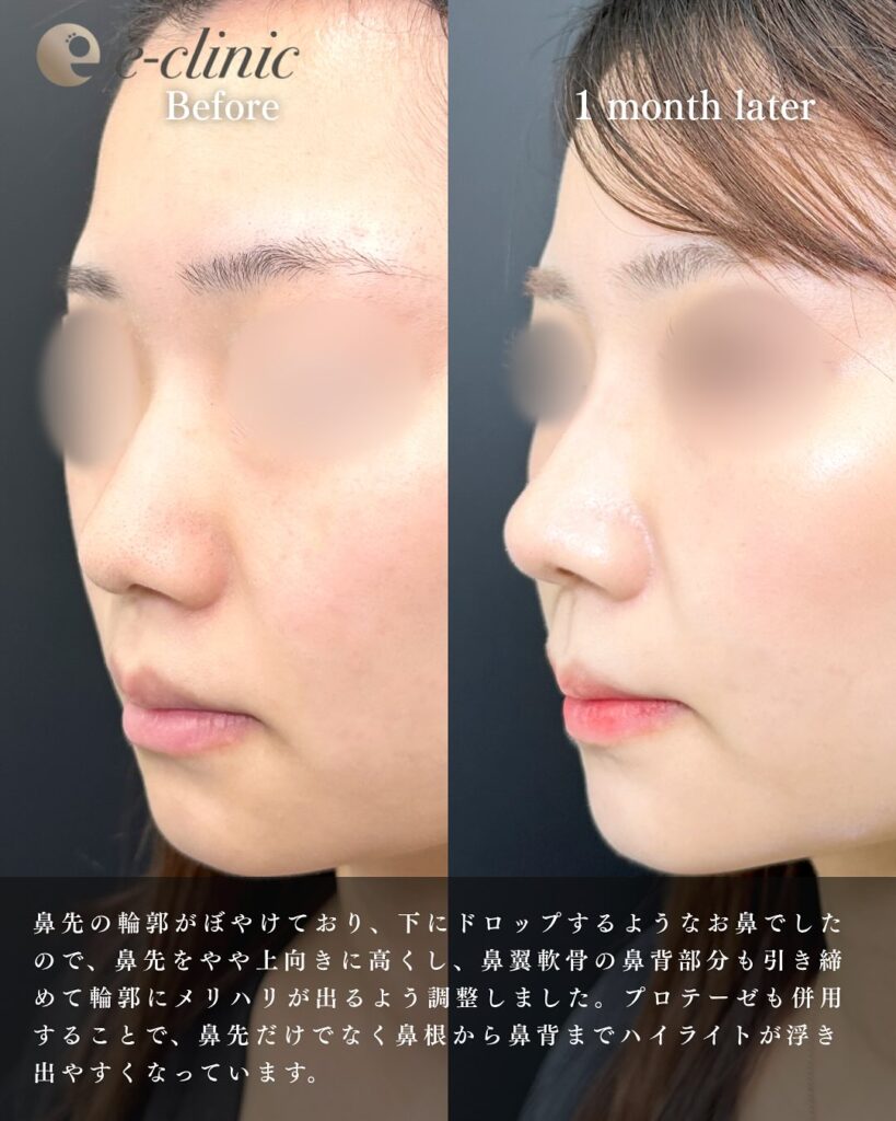 鼻尖形成と軟骨移植とプロテーゼの症例写真 (23)