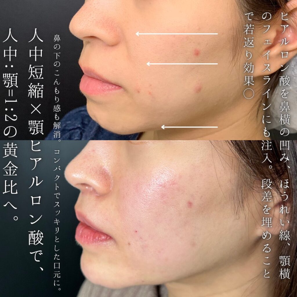人中短縮と顎、法令線のヒアルロン酸の症例写真 (2)