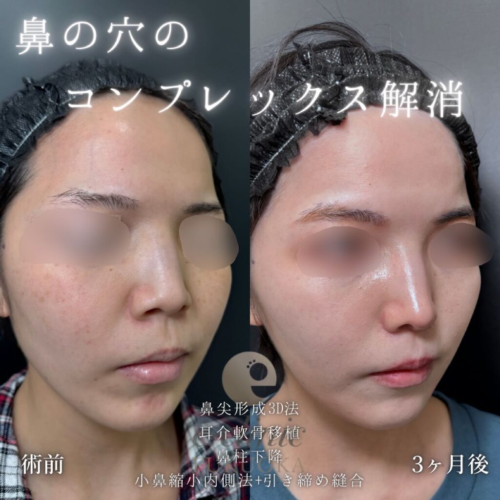 鼻尖形成と軟骨移植と鼻柱下降と小鼻縮小の症例写真 (5)