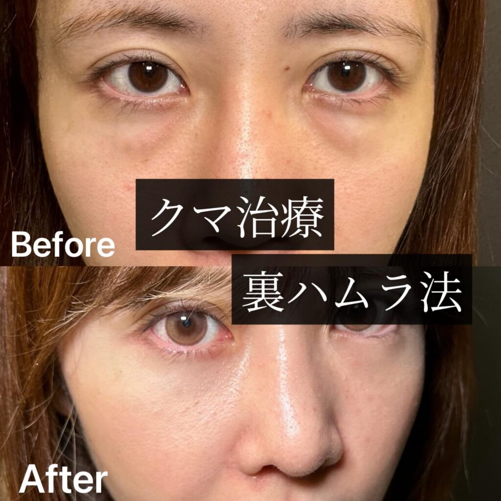 裏ハムラ法の症例写真 (17)