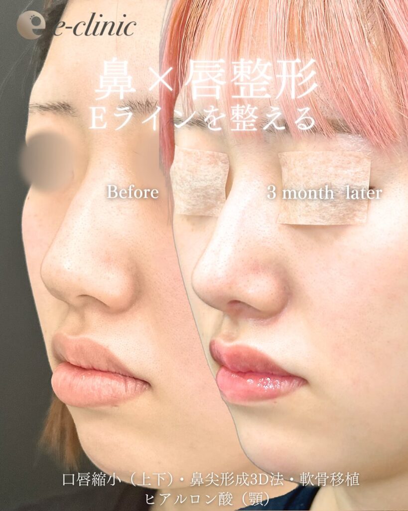 鼻尖形成と軟骨移植と口唇縮小の症例写真 (4)