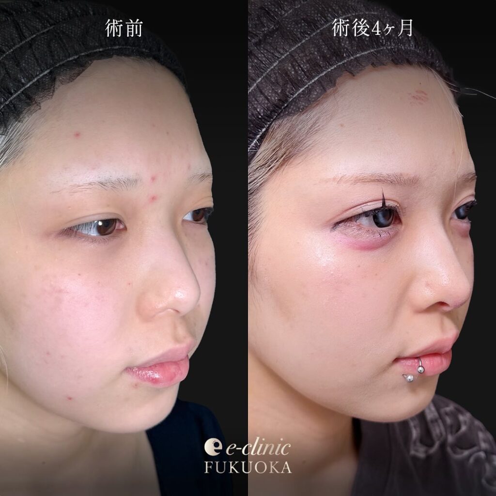 鼻尖形成と軟骨意欲と小鼻縮小の症例写真 (3)