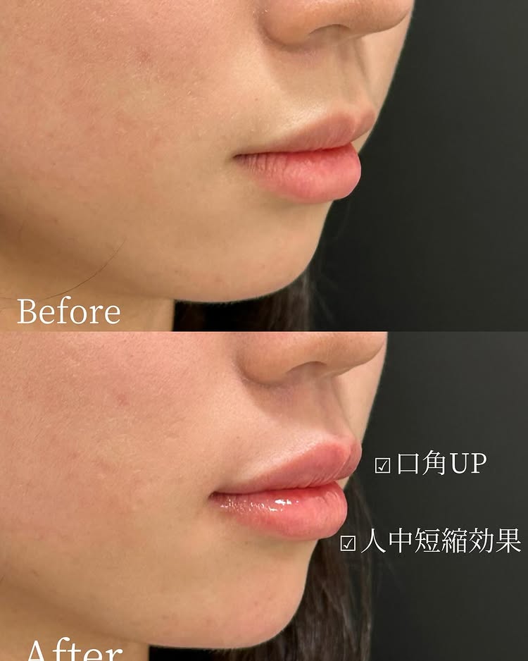 唇のヒアルロン酸の症例写真 (45)