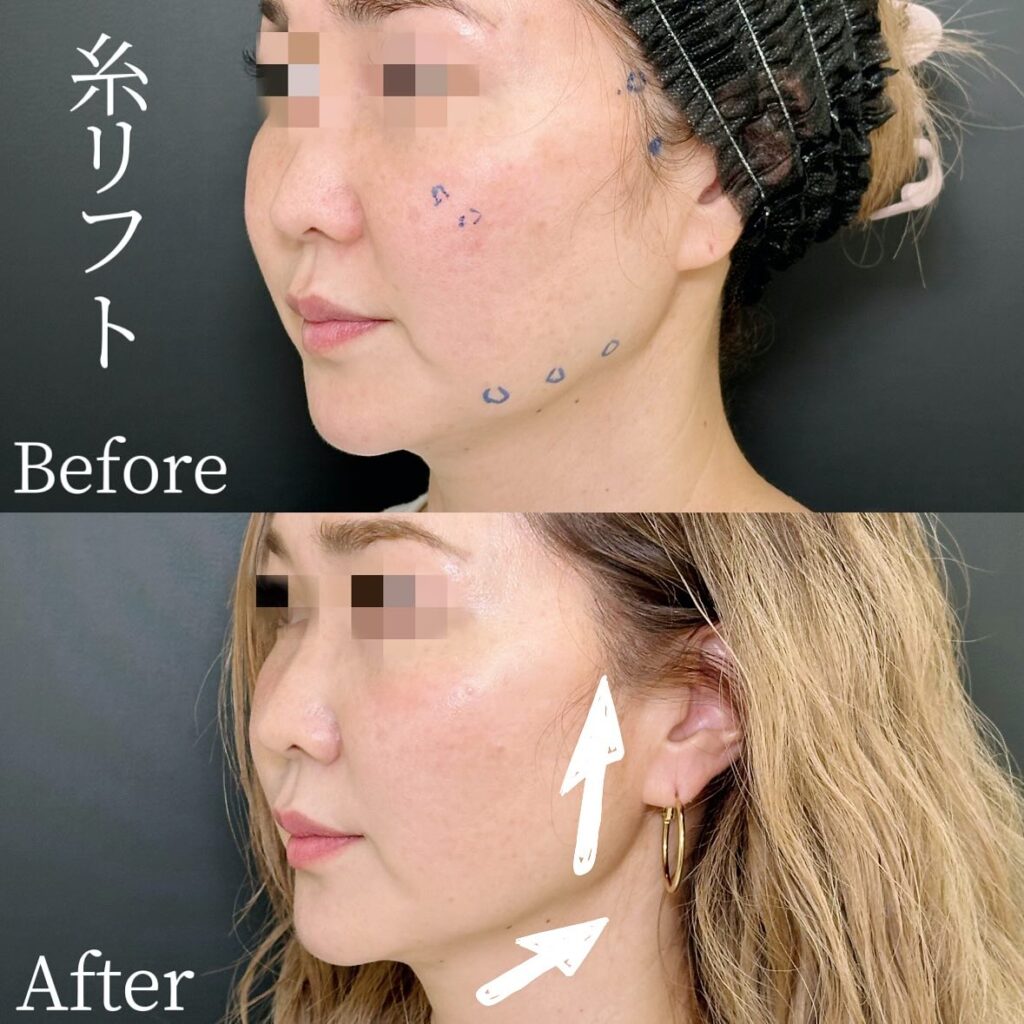 糸リフトの症例写真 (25)