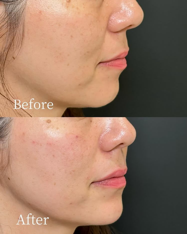 法令線のヒアルロン酸の症例写真 (24)