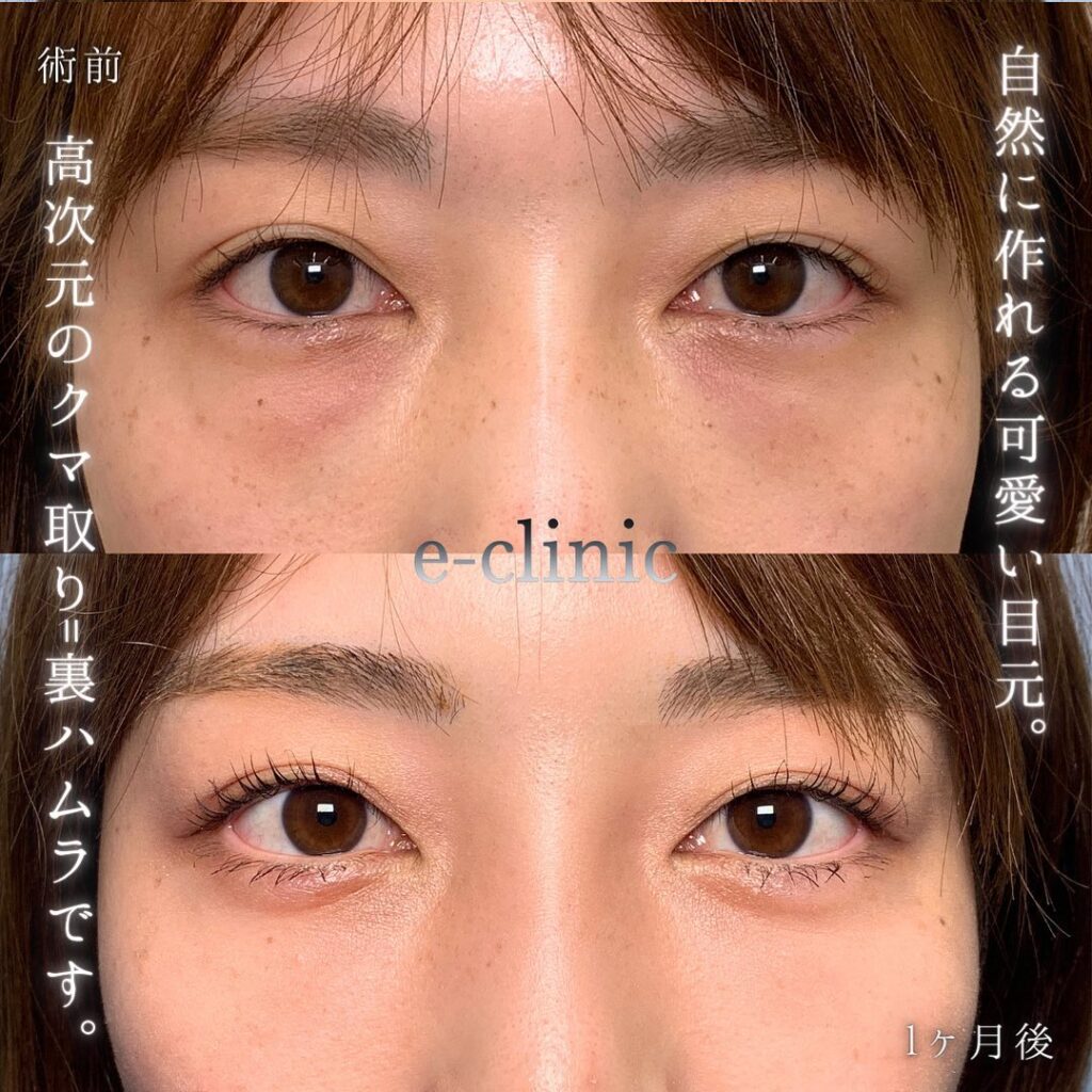 裏ハムラ法の症例写真 (18)