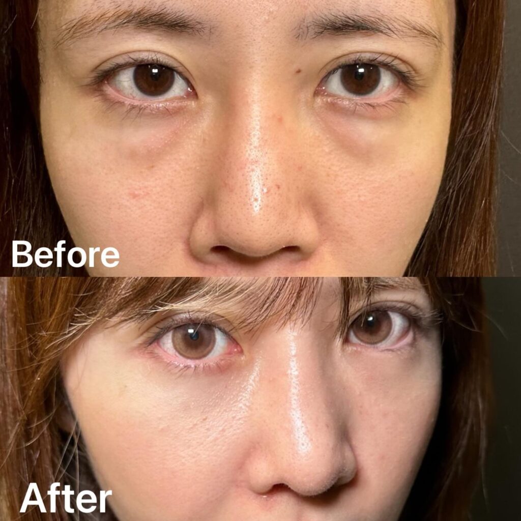 裏ハムラ法の症例写真 (18)