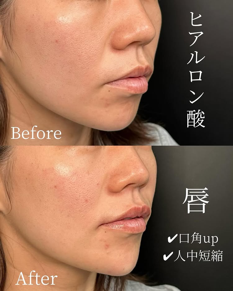 唇のヒアルロン酸の症例写真 (54)