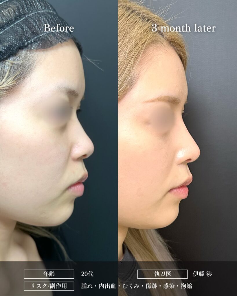 鼻尖形成と軟骨移植とプロテーゼと小鼻縮小の症例写真 (13)