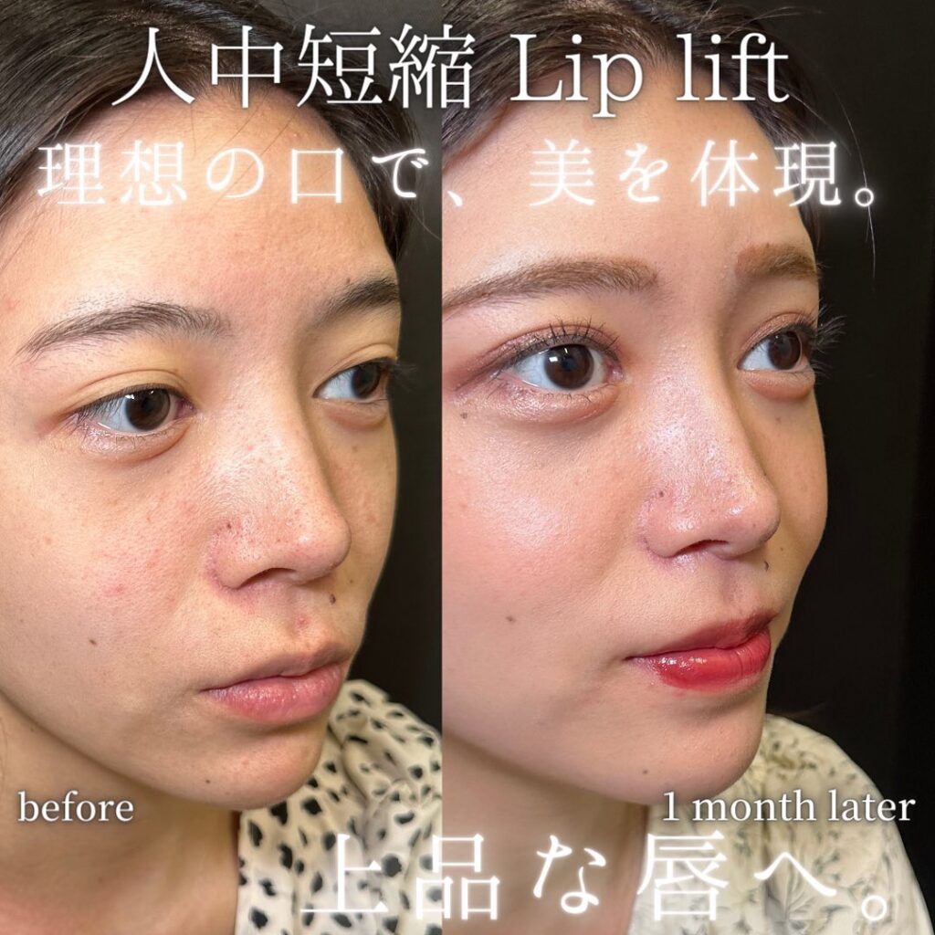 人中短縮の症例写真 (1)