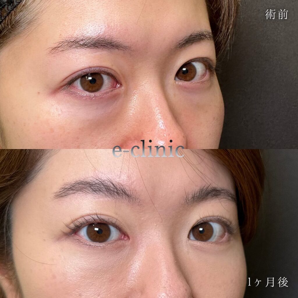 裏ハムラ法の症例写真 (25)