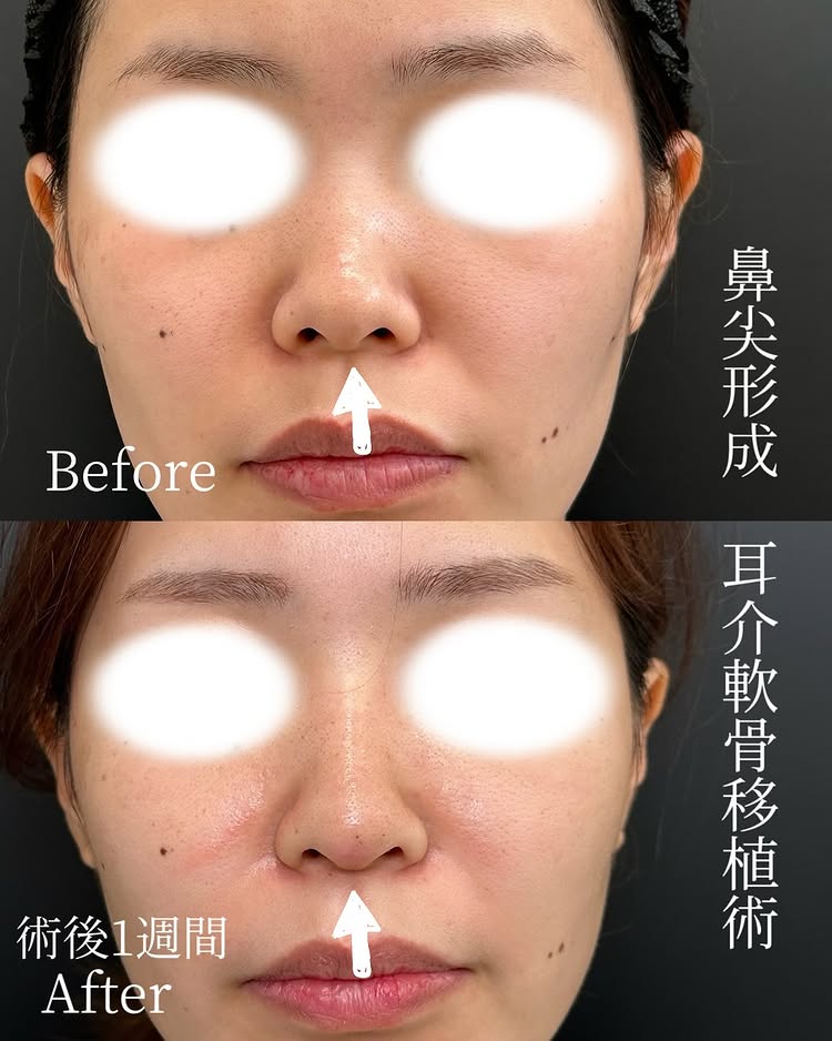 鼻尖形成と軟骨移植の症例写真 (15)