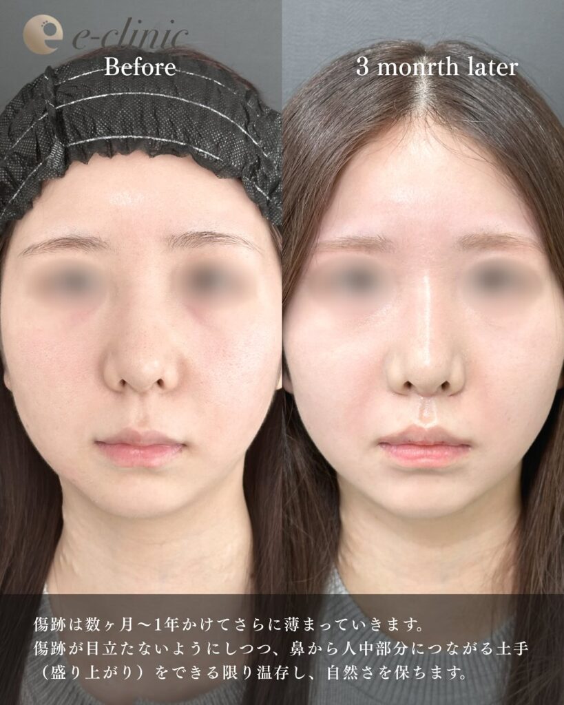 人中短縮の症例写真 (26)