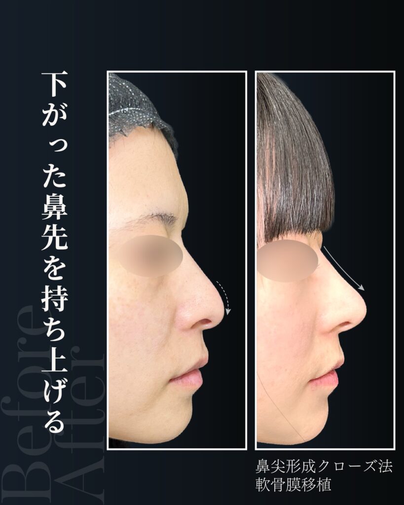 鼻尖形成と軟骨移植の症例写真 (35)