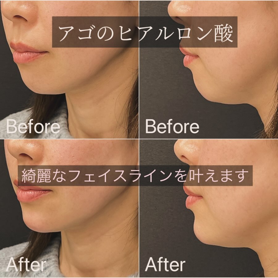 顎のヒアルロン酸の症例写真 (1)