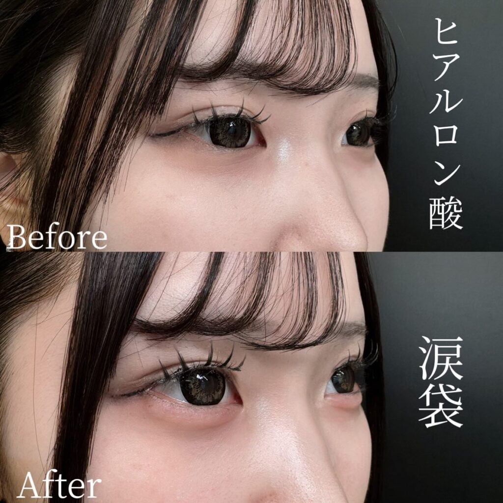 涙袋のヒアルロン酸の症例写真 (7)