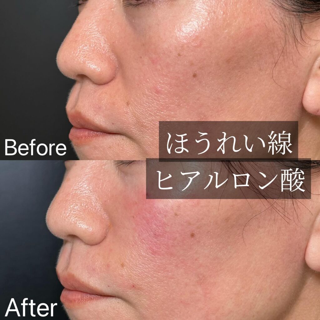 法令線のヒアルロン酸の症例写真 (5)