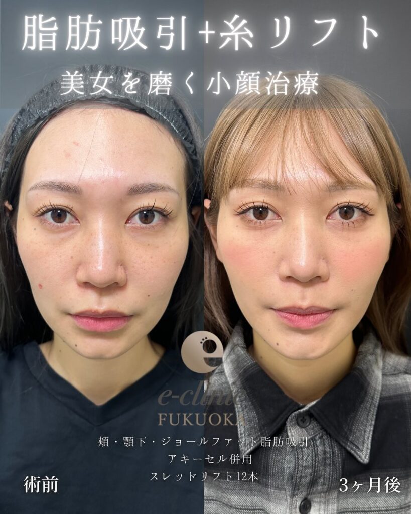 頬と顎下の脂肪吸引とジョールファットと糸リフトの症例写真 (1)