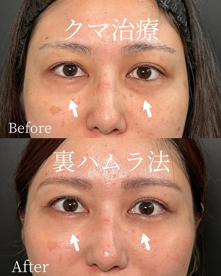 裏ハムラ法の症例写真 (73)