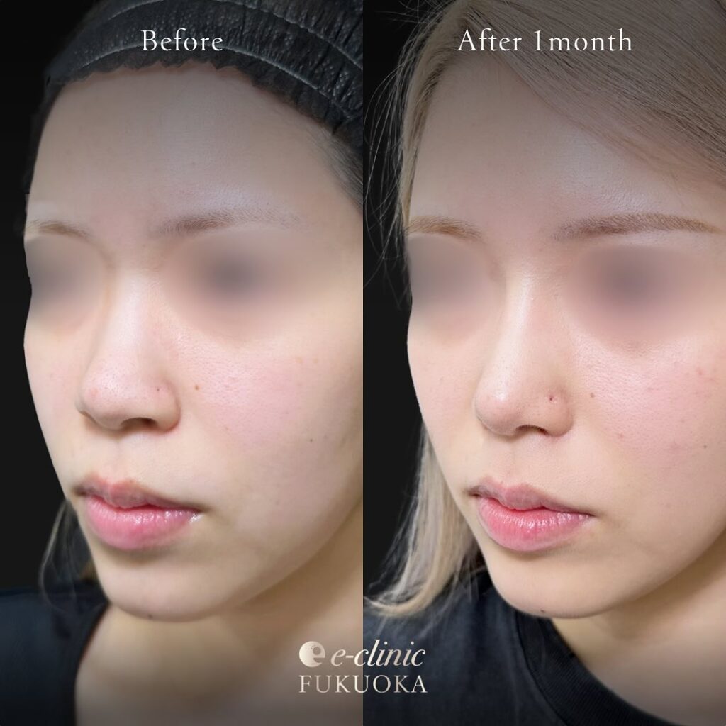 鼻尖形成と軟骨移植とプロテーゼと小鼻縮小の症例写真 (7)