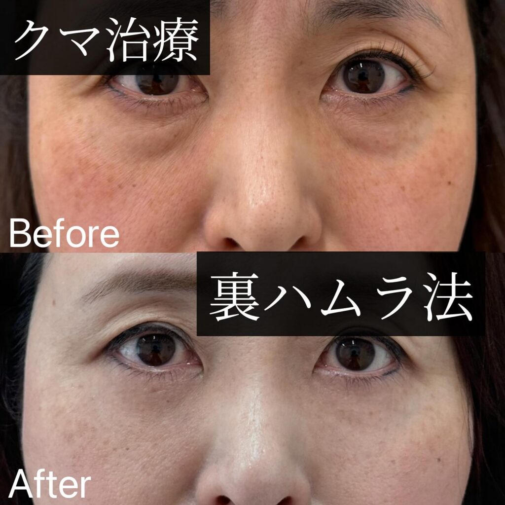 裏ハムラ法の症例写真 (21)