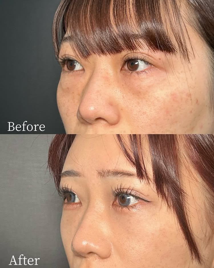 裏ハムラ法の症例写真 (94)