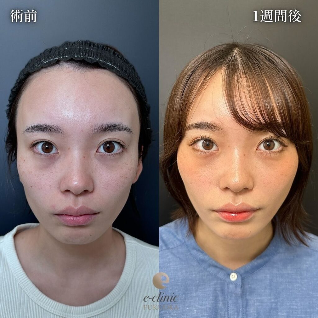 糸リフトの症例写真 (6)