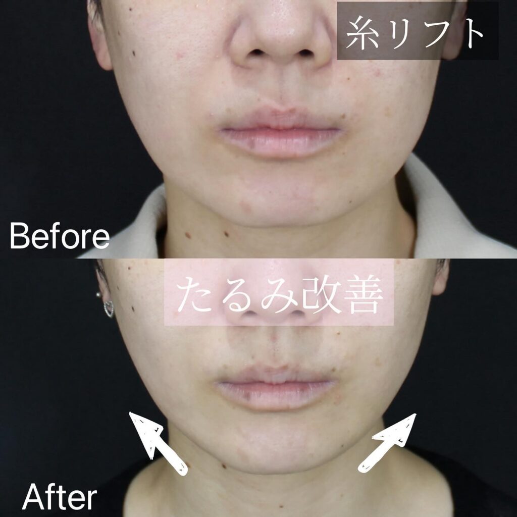 糸リフトの症例写真 (6)