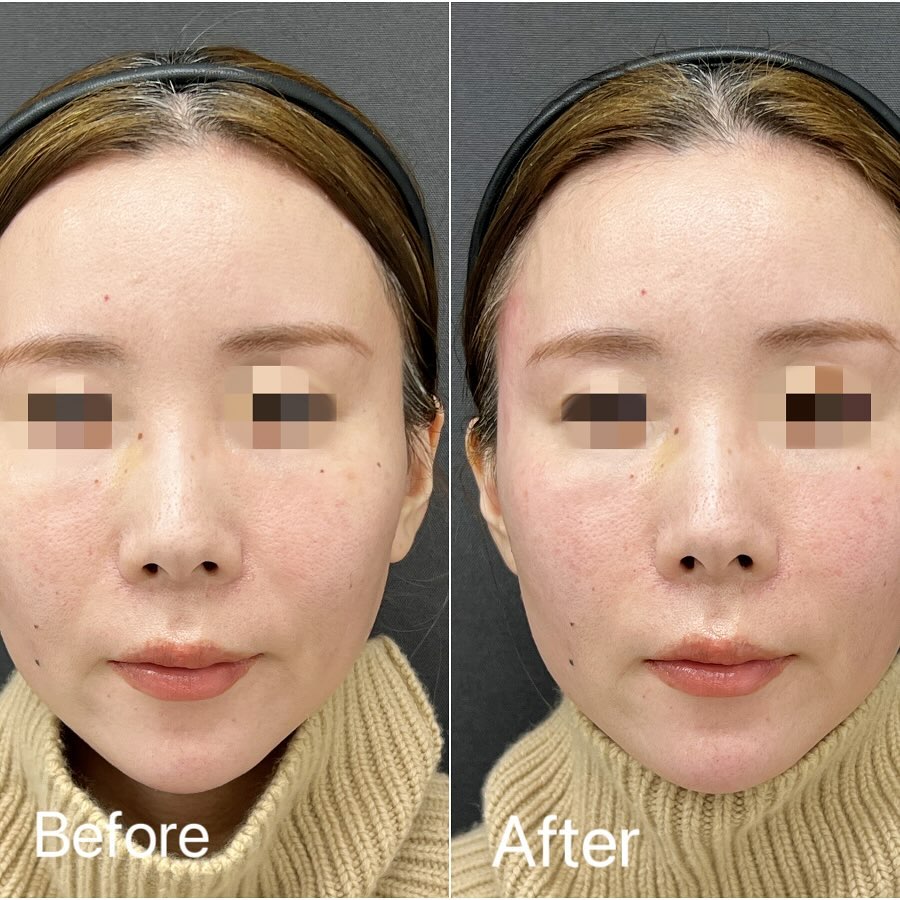 法令線のヒアルロン酸の症例写真 (2)