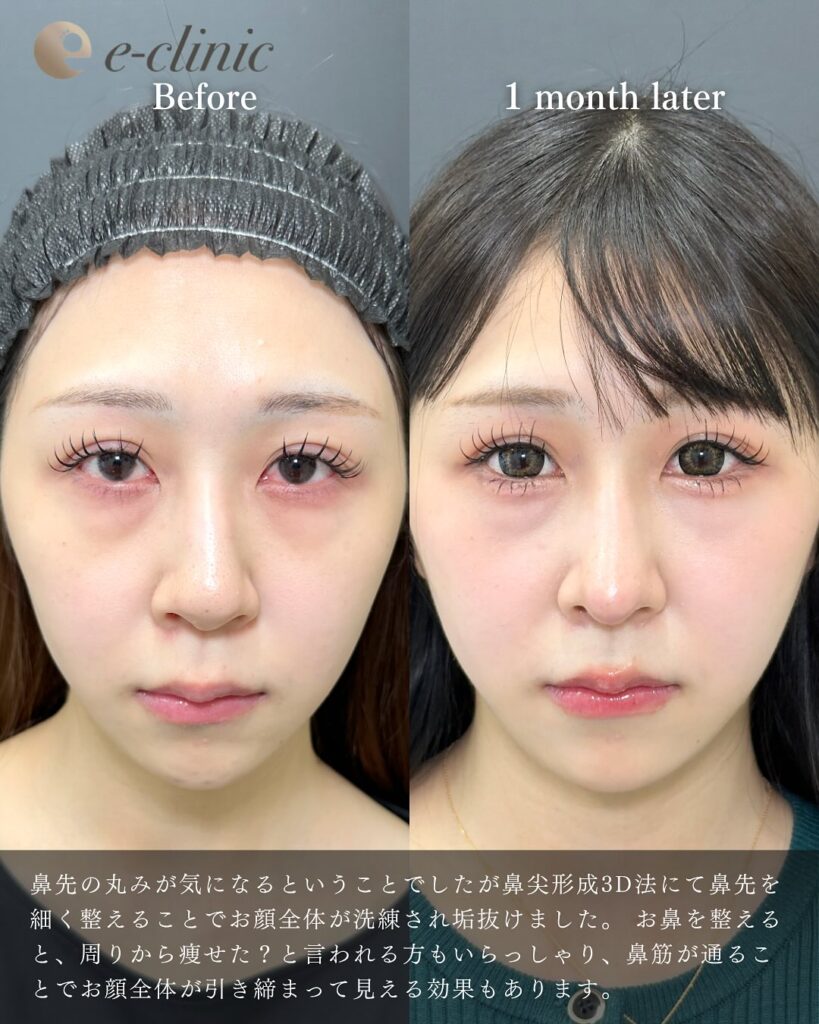 鼻中隔延長と鼻尖形成と軟骨移植と鷲鼻修正の症例写真 (5)