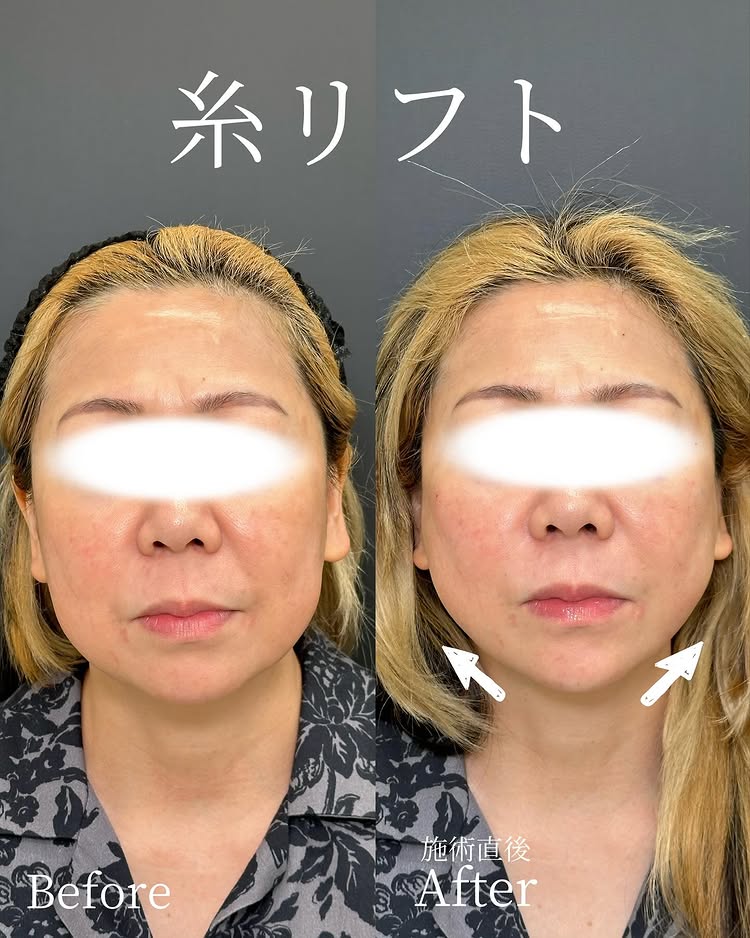 糸リフトの症例写真 (48)