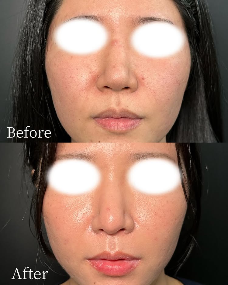 鼻尖形成の症例写真 (2)