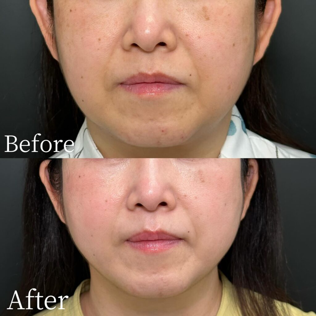 糸リフトの症例写真 (19)