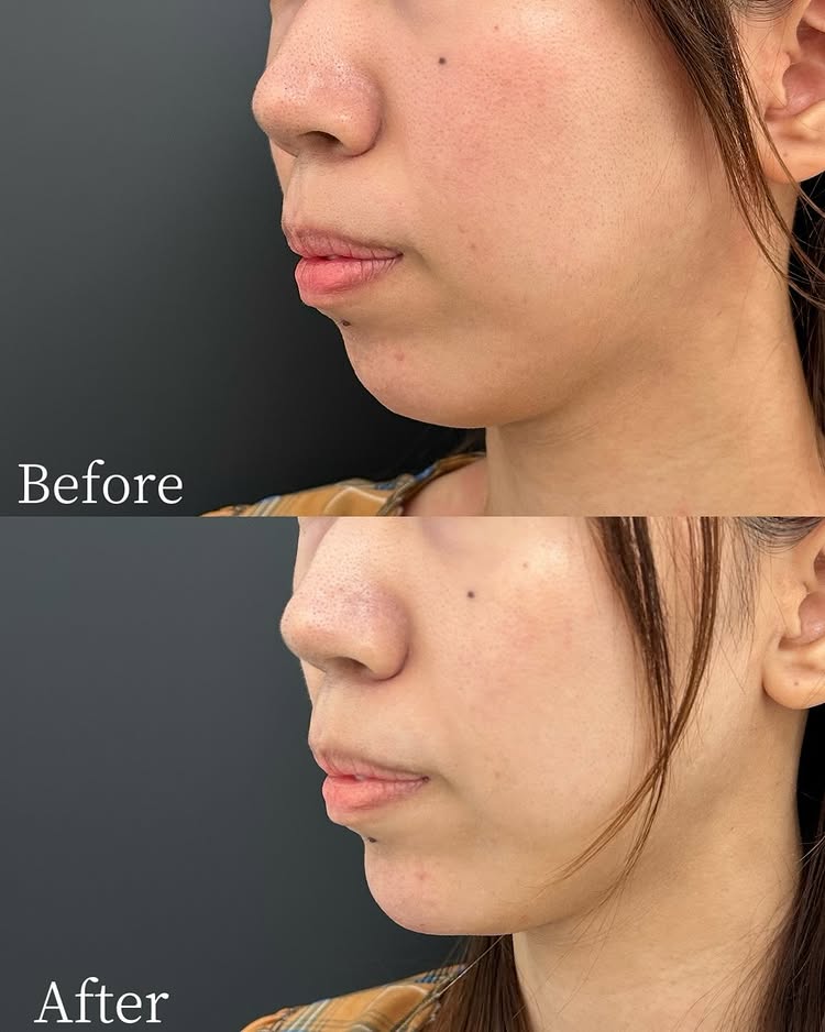 顎のヒアルロン酸の症例写真 (34)