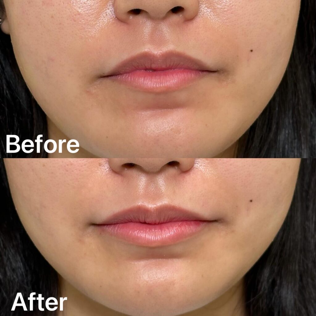 唇のヒアルロン酸の症例写真 (27)
