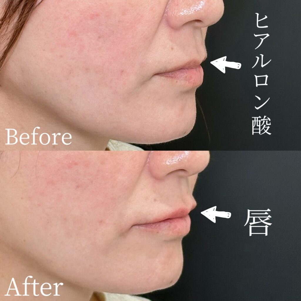 唇のヒアルロン酸の症例写真 (28)